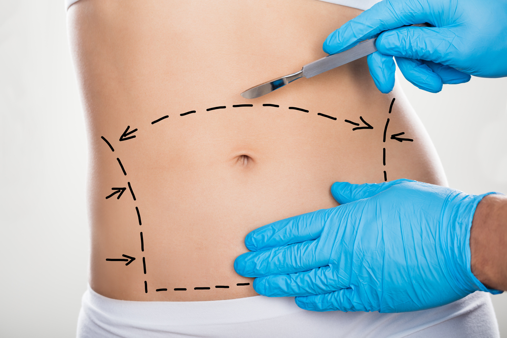 ABDOMINOPLASTIE TUNISIE