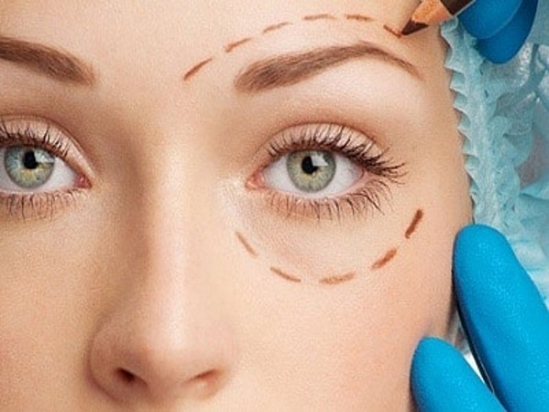 blepharoplastie Tunisie