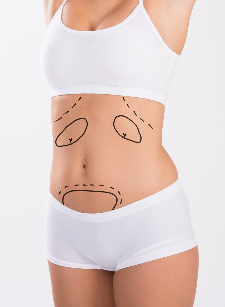 ABDOMINOPLASTIE TUNISIE