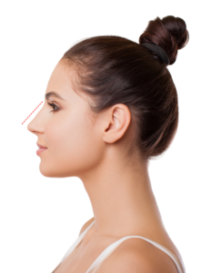 Rhinoplastie Tunisie