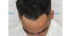 after greff cheveux Tunisie