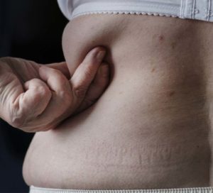 Liposuccion: quelles zones peut-elle traiter